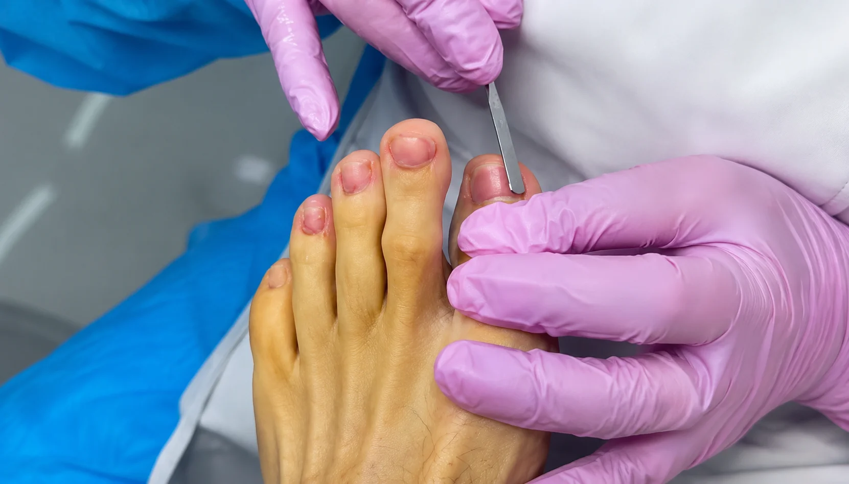Fluorización para uñas amarillas